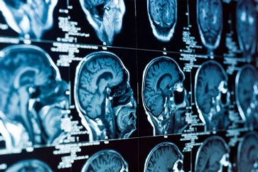Brain Injuries